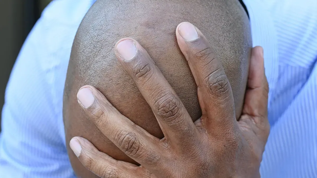 What is the difference between different FUE punch diameters?